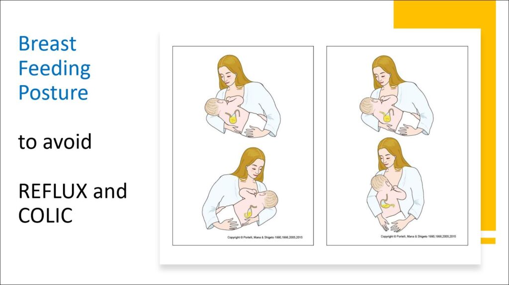 Breast Feeding Poster to avoid Reflux and Colic Visceral Biomechanics